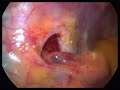 Exploration for hiatus hernia in gastric banding