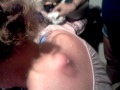 Biggest pimple ever