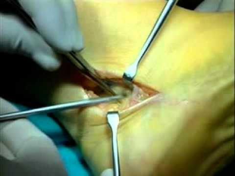 SINDROME DEL CANAL TARSIANO.Tarsal tunnel syndrome