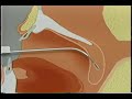 somnoplastia