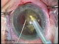 Phacoemulsification in Anterior Megalophthalmos