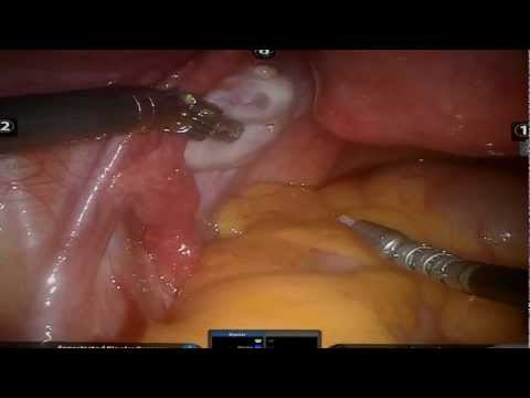 how to drain ovarian cyst