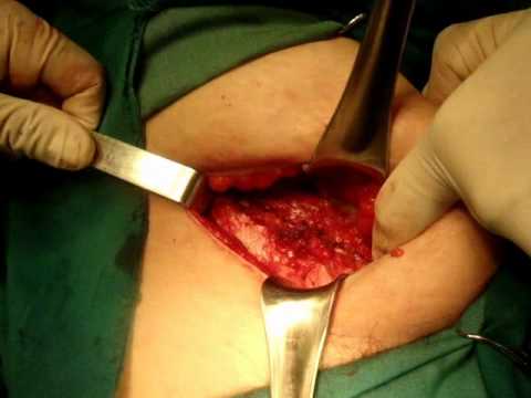 hernioplastia - Paciente apendicectomizada hace 20 años - Hernia Incisional - Se sibulciona el tejido , se repara el defecto de pared - Se coloca la Malla.