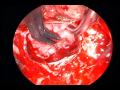 pituitary adenoma, endoscopic endonasal