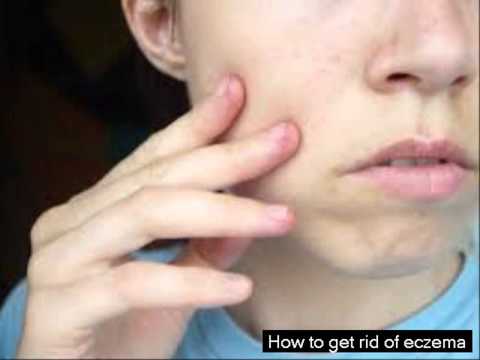 how to remove eczema scars