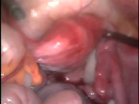 cirurgia de cisto