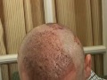 Best hair transplant - 