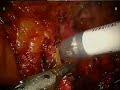 Robotic Right Para-aortic Lymphadenectomy Robotic Right Para-aortic Lymphadenectomy