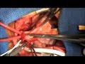 videos de Hypoplastic Left Heart Syndrome