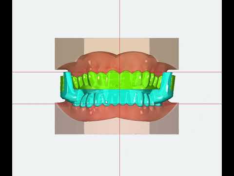 Snoring splint splint