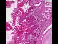 Histopathology Lung -- Squamous cell carcinoma