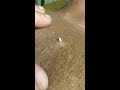 Volcano blackhead 2