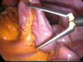 videos de laparoscopic excision of choledochal cyst type I