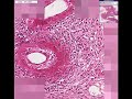 Histopathology Adrenal gland --Polyarteritis Histopathology Adrenal gland --Polyarteritis