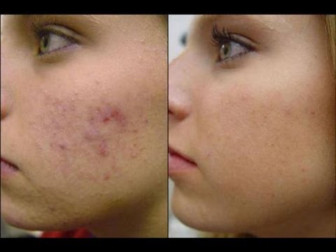 DermTV - Treating Post Acne Brown Spots (Hyperpigmentation) [DermTV.com Epi # 248]