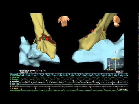 how to perform vt ablation