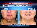 Implantes Múltiplos CIR Brasília (61) 3346-9001 Implantes Múltiplos CIR Brasília (61) 3346-9001