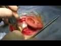 Cochlear implant part 2!