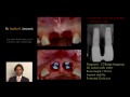 002-10 Immediate Tooth Replacement: Extraction and Healed sites PREVIEW
