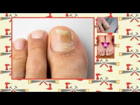 how to dissolve toenail fungus