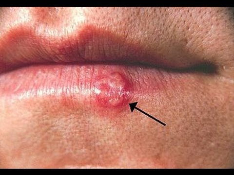 how to treat herpes with dmso