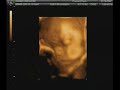 3D Ultrasound 31 weeks (Gianno)