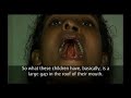 Operation Cleft Australia Operation Cleft Australia