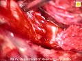 Neurosurgery video petroclival meningioma 1