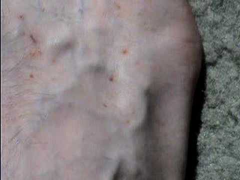 Lesions