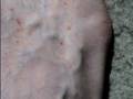 Lesions