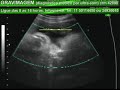GRAVIMAGEM 915 (ULTRA-SOM 3D 4D GRAVIDEZ  COM 36 SEMANAS)