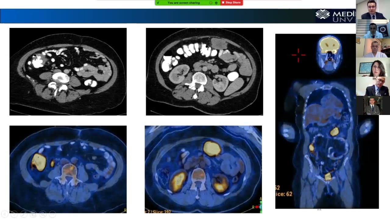 Staging and Surgical Preparation for Colorectal Cancer