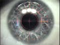 My LASEK Eye Surgery My LASEK Eye Surgery