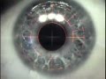 My LASEK Eye Surgery