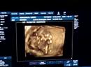3D ultrasound at 12 weeks (2)