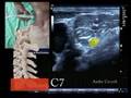 sonoanatomie du plexus brachial et des vertebres cervicales