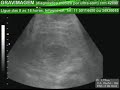 GRAVIMAGEM 871 (ULTRA-SOM GRAVIDEZ 15 SEMANAS)