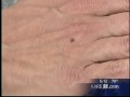 Lyme Disease special