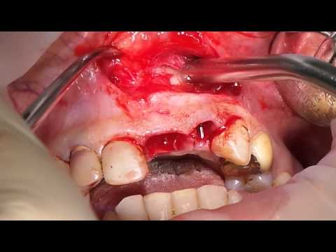 Удаление радикулярной кисты верхней челюсти хирурги-ческим путем. Часть 1