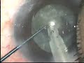Phacoemulsification With Foldable IOL Implantation Phacoemulsification With Foldable IOL Implantation