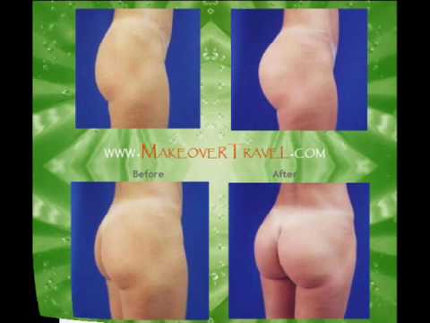 ass injections
