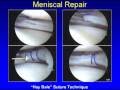 Torn Meniscus Cartilage Overview