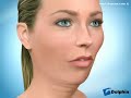 Mandibular Advancement Surgery Dental