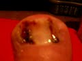Ingrown Toenail Post Operation / Surgery