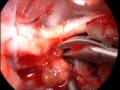 Craniopharyngioma Craniopharyngioma