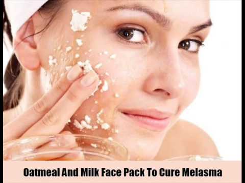 how to treat melasma