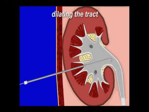 how to drain nephrostomy tube