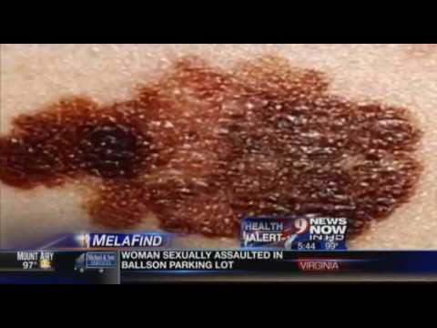 Dr. Elizabeth Tanzi discusses MelaFind on WUSA9