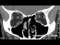 ENS lateral wall