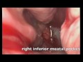A video displaying surgery on a patient with Empty Nose Syndrome after previous inferior turbinate excision (ENS-IT). The mucosa of the inferior meatus is expanded from below with an acellular dermal graft to create a 